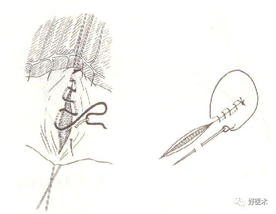 缝线怎么打结外科手术操作 ｜ 打开手术通路之缝合打结_https://www.jmylbn.com_新闻资讯_第10张