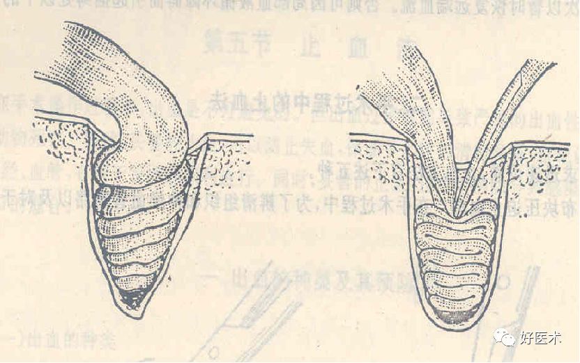 为什么要结扎血管外科手术操作 ｜ 打开手术通路之结扎止血_https://www.jmylbn.com_新闻资讯_第4张