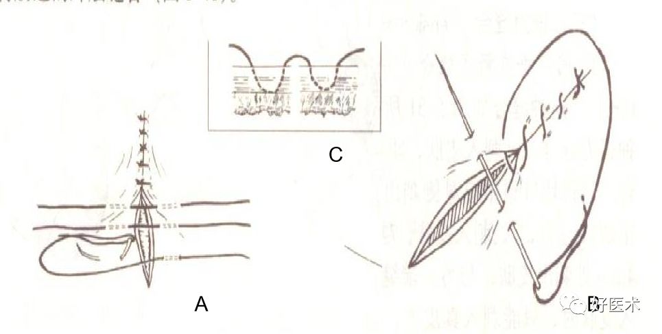 缝线怎么打结外科手术操作 ｜ 打开手术通路之缝合打结_https://www.jmylbn.com_新闻资讯_第9张