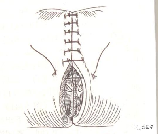 缝线怎么打结外科手术操作 ｜ 打开手术通路之缝合打结_https://www.jmylbn.com_新闻资讯_第5张