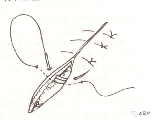 缝线怎么打结外科手术操作 ｜ 打开手术通路之缝合打结_https://www.jmylbn.com_新闻资讯_第3张