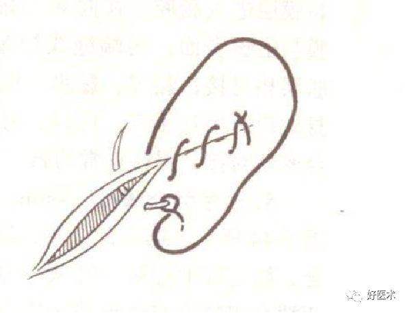 缝线怎么打结外科手术操作 ｜ 打开手术通路之缝合打结_https://www.jmylbn.com_新闻资讯_第7张