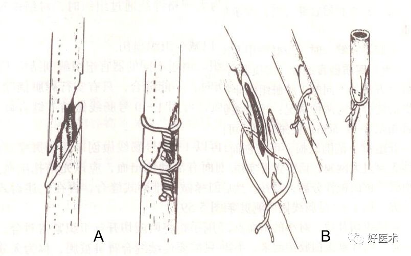 缝线怎么打结外科手术操作 ｜ 打开手术通路之缝合打结_https://www.jmylbn.com_新闻资讯_第15张