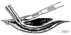 分离结扎钳怎么用【学生频道】外科手术基本功速成法，书上学不到的秘诀！（聂邯洛医师推荐）_https://www.jmylbn.com_新闻资讯_第64张