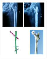 生物钉是什么材料骨折常用内固定材料&选择原则，超详细！_https://www.jmylbn.com_新闻资讯_第82张