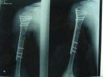 生物钉是什么材料骨折常用内固定材料&选择原则，超详细！_https://www.jmylbn.com_新闻资讯_第97张