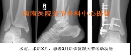 生物钉是什么材料骨折常用内固定材料&选择原则，超详细！_https://www.jmylbn.com_新闻资讯_第103张