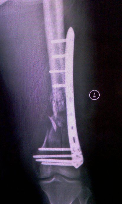 生物钉是什么材料骨折常用内固定材料&选择原则，超详细！_https://www.jmylbn.com_新闻资讯_第86张