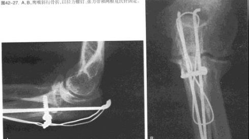 生物钉是什么材料骨折常用内固定材料&选择原则，超详细！_https://www.jmylbn.com_新闻资讯_第100张
