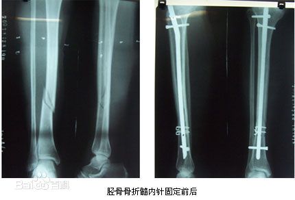 生物钉是什么材料骨折常用内固定材料&选择原则，超详细！_https://www.jmylbn.com_新闻资讯_第90张