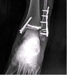 生物钉是什么材料骨折常用内固定材料&选择原则，超详细！_https://www.jmylbn.com_新闻资讯_第102张