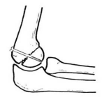 生物钉是什么材料骨折常用内固定材料&选择原则，超详细！_https://www.jmylbn.com_新闻资讯_第99张