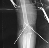 生物钉是什么材料骨折常用内固定材料&选择原则，超详细！_https://www.jmylbn.com_新闻资讯_第98张