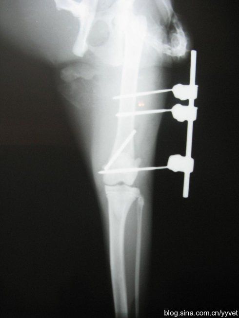 生物钉是什么材料骨折常用内固定材料&选择原则，超详细！_https://www.jmylbn.com_新闻资讯_第85张