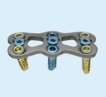 生物钉是什么材料骨折常用内固定材料&选择原则，超详细！_https://www.jmylbn.com_新闻资讯_第96张