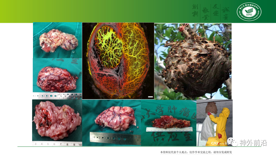 中山肿瘤牟永告:胶质瘤边界 之我见