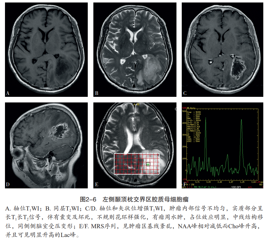 膠質母細胞瘤的mri特點有哪些?_醫學界-助力醫生臨床決策和職業成長