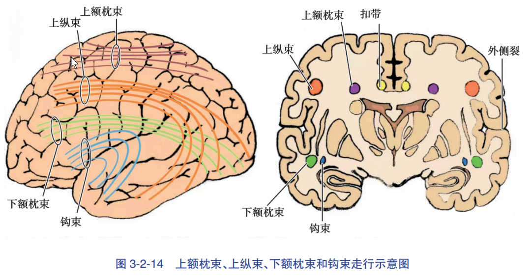 经前额叶侧方(额中回)入路基底节区脑出血清除术应用解剖_医学界-助力