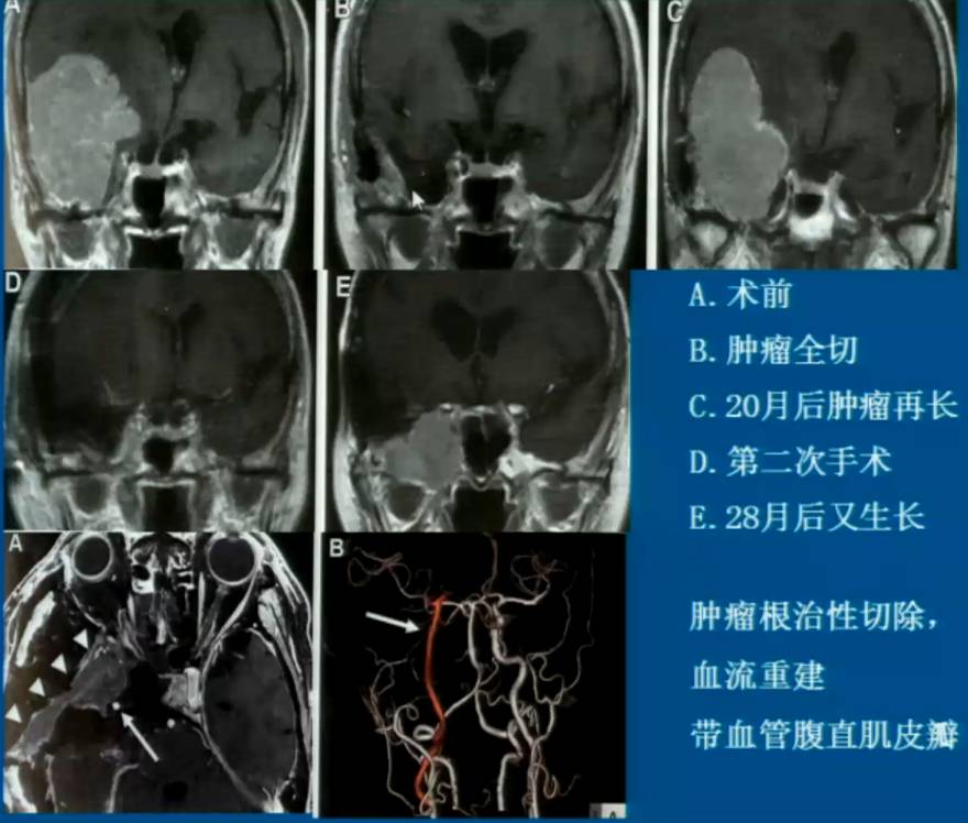 演讲 301医院周定标 颅底高风险脑膜瘤如何选择治疗方式不恰当的微创恰恰是有创 自由微信 Freewechat