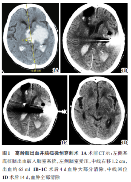 106歲高齡腦出血並腦疝微創穿刺1例_醫學界-助力醫生臨床決策和職業