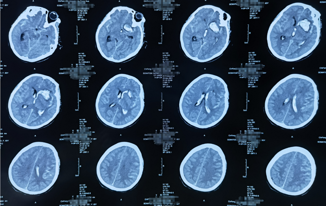 頭部ct(外院,2021-4-25):左側基底節區腦出血破入腦室,蛛網膜下腔出血