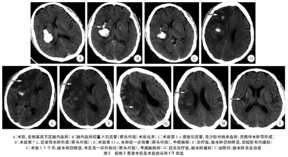 颅脑手术后迟发性脑水肿的临床分析 | 临床神经外科_医学界-助力医生
