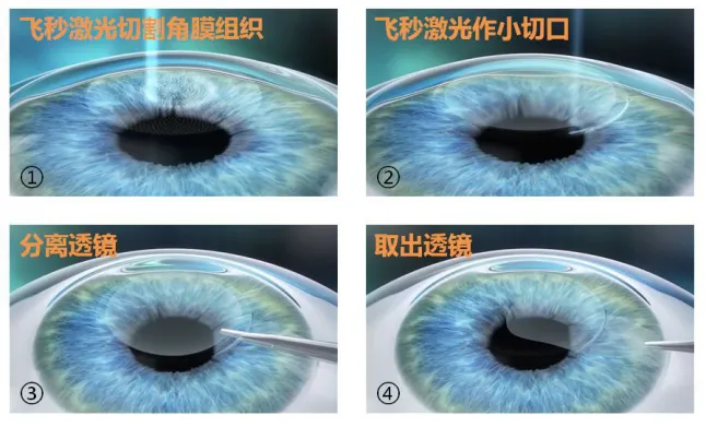 全飞秒、半飞秒和表层手术对比详解