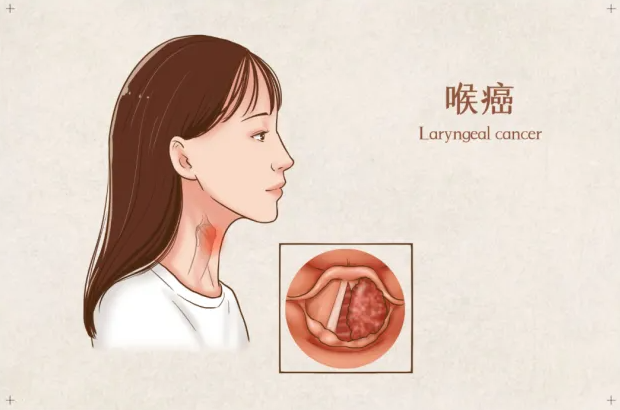 声带白斑意即声带粘膜表面凸起的灰白色斑片样物,声带白斑病因很多,与