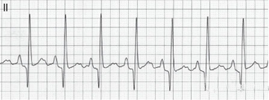 心电图滤波怎么选择【知跃干货】心电图基本示例_https://www.jmylbn.com_新闻资讯_第18张