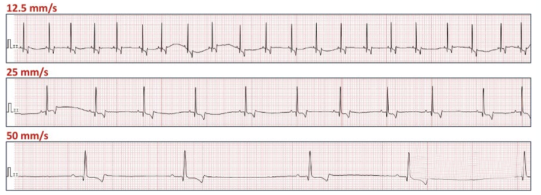 心电图滤波怎么选择【知跃干货】心电图基本示例_https://www.jmylbn.com_新闻资讯_第16张
