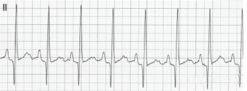 心电图滤波怎么选择【知跃干货】心电图基本示例_https://www.jmylbn.com_新闻资讯_第17张