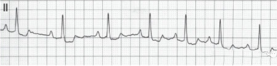 心电图滤波怎么选择【知跃干货】心电图基本示例_https://www.jmylbn.com_新闻资讯_第19张