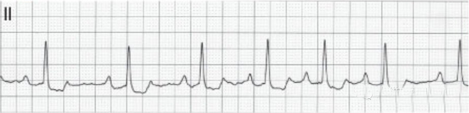心电图滤波怎么选择【知跃干货】心电图基本示例_https://www.jmylbn.com_新闻资讯_第20张