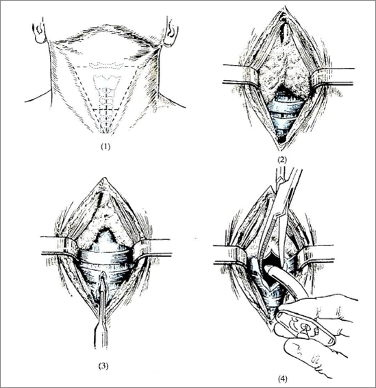 患者怎么选择人工鼻【硬核科普】气管切开的居家护理_https://www.jmylbn.com_新闻资讯_第4张