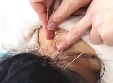 南川妇幼保健院怎么样医院动态丨冬病冬防，南川区妇幼保健院中医科“三九贴” 来啦！_https://www.jmylbn.com_新闻资讯_第20张