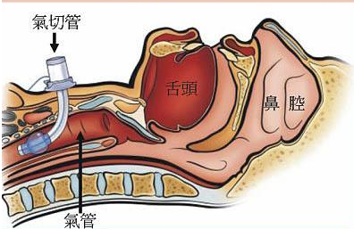 气管套管怎么换药【康复科普】气管切开患者的居家护理之三避免意外脱管_https://www.jmylbn.com_新闻资讯_第6张