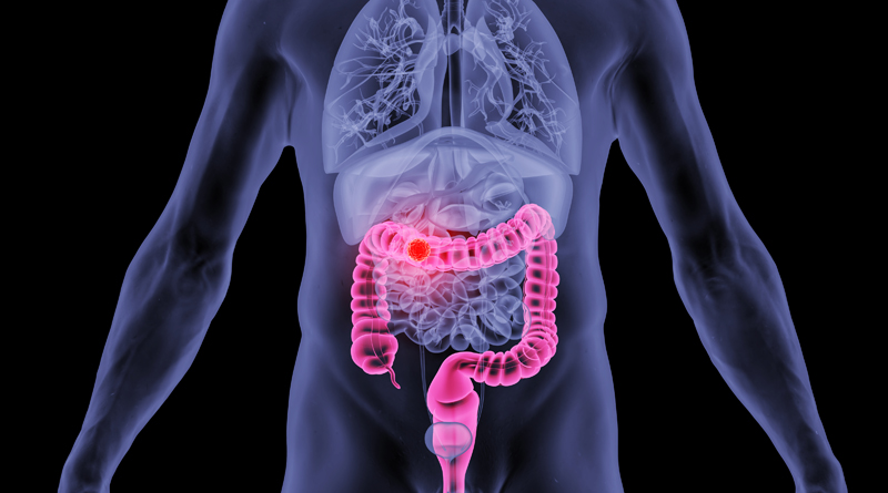 化疗为什么用泵诧异！为何国内建议先化疗，美国医生却直接一次性切除7个病灶？_https://www.jmylbn.com_新闻资讯_第4张