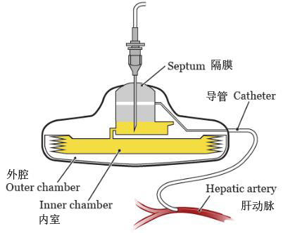 化疗为什么用泵诧异！为何国内建议先化疗，美国医生却直接一次性切除7个病灶？_https://www.jmylbn.com_新闻资讯_第10张