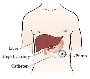 化疗为什么用泵诧异！为何国内建议先化疗，美国医生却直接一次性切除7个病灶？_https://www.jmylbn.com_新闻资讯_第11张
