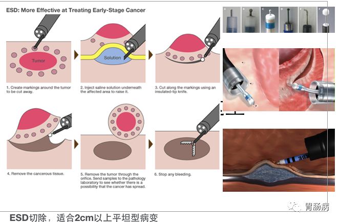 为什么说热活检钳胃肠息肉是怎么长出来的？有什么危害？如何预防和治疗？_https://www.jmylbn.com_新闻资讯_第12张