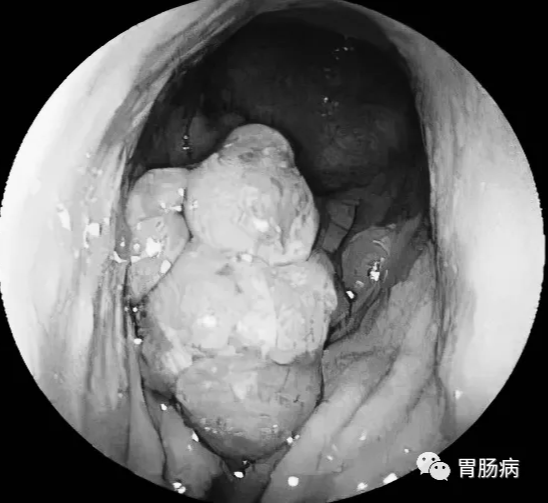 结果,不出所料,距肛门17-20cm处,一巨大菜花状占位性肿物,质硬脆,易