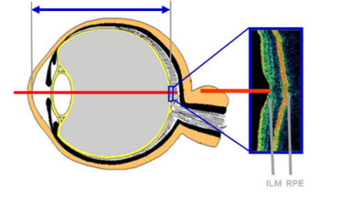 眼科生物测量仪怎么看科普：如何快速看懂生物测量仪检查报告？_https://www.jmylbn.com_新闻资讯_第14张