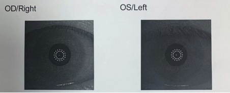 眼科生物测量仪怎么看轻松看懂眼科光学生物测量仪报告单_https://www.jmylbn.com_新闻资讯_第4张