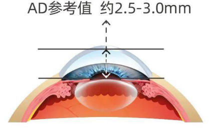 眼科生物测量仪怎么看科普：如何快速看懂生物测量仪检查报告？_https://www.jmylbn.com_新闻资讯_第11张