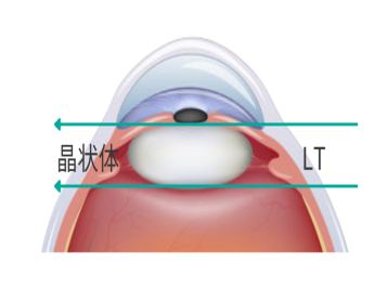 眼科生物测量仪怎么看科普：如何快速看懂生物测量仪检查报告？_https://www.jmylbn.com_新闻资讯_第12张