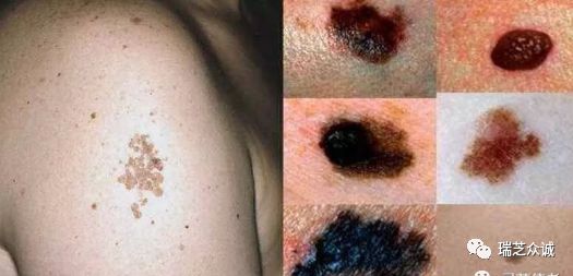 灵芝对皮肤癌的辅助调理效果很好