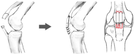 扎骨针怎么装髌骨下极粉碎骨折怎么办？7种固定技术详解与术式选择_https://www.jmylbn.com_新闻资讯_第21张