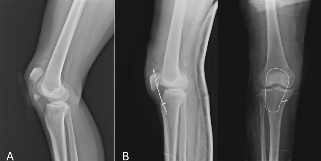 扎骨针怎么装髌骨下极粉碎骨折怎么办？7种固定技术详解与术式选择_https://www.jmylbn.com_新闻资讯_第23张