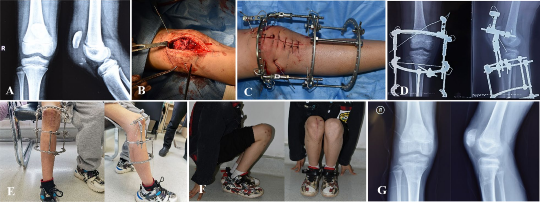 扎骨针怎么装髌骨下极粉碎骨折怎么办？7种固定技术详解与术式选择_https://www.jmylbn.com_新闻资讯_第6张