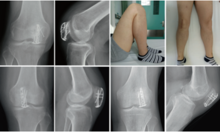 扎骨针怎么装髌骨下极粉碎骨折怎么办？7种固定技术详解与术式选择_https://www.jmylbn.com_新闻资讯_第20张